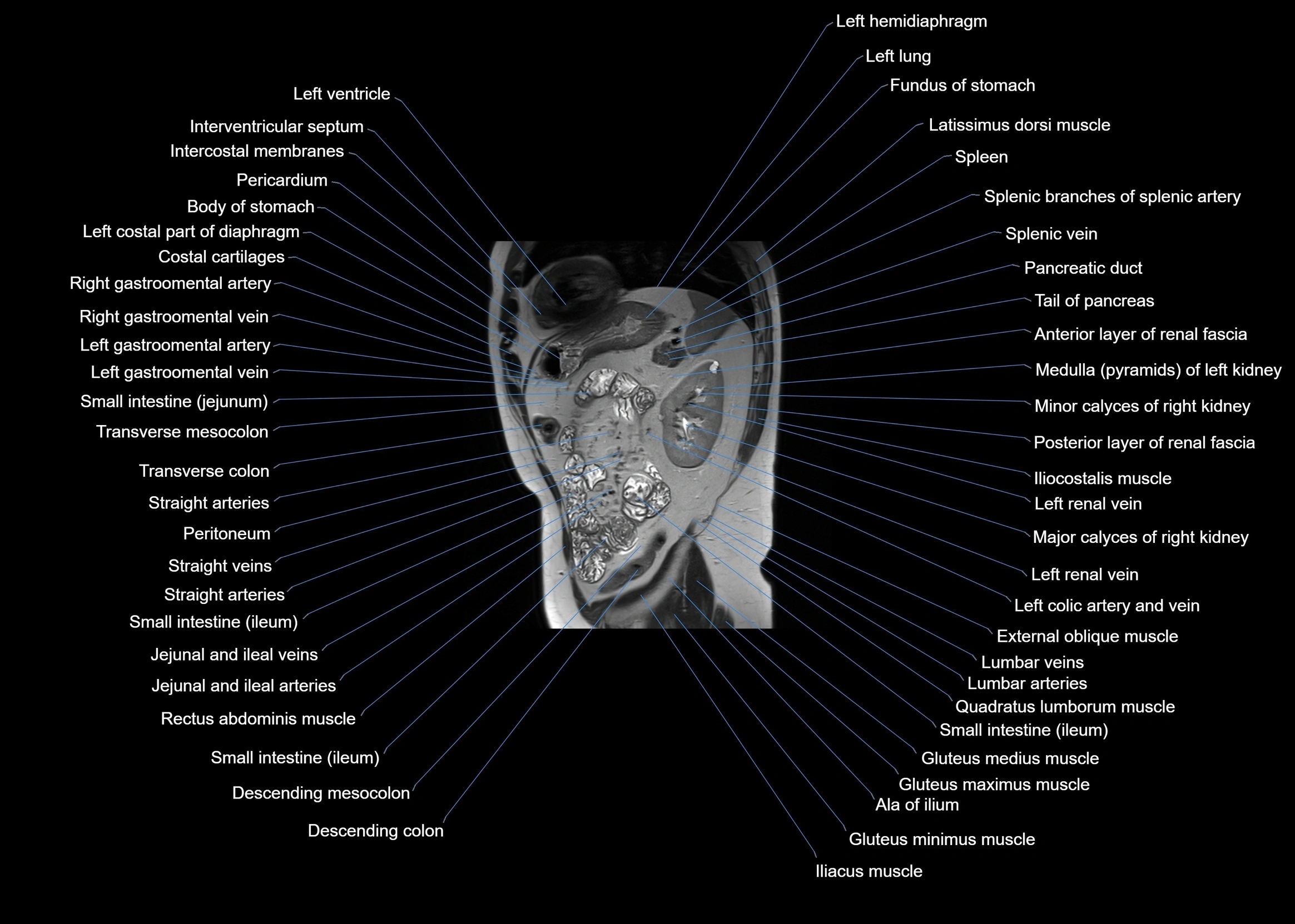 MRI abdomen sagittal cross sectional anatomy  radiology  image-img-00001-00051.webp